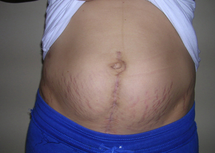 Ů���ʸ�����Ķ�Ƥ �Ҳ��̶�